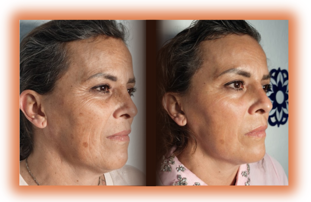 CURSO PROFESIONAL EN MICRONEEDLING (2000 × 800 px) (7)